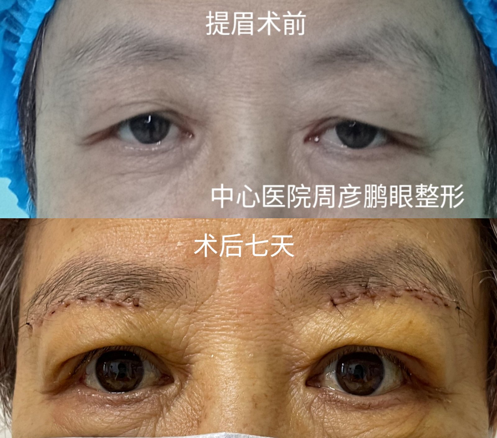 眉下切口上睑皮肤松弛矫正术,下睑袋修整 眶隔脂肪释放转移术病案实例