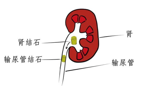 尿结石位置图片图片