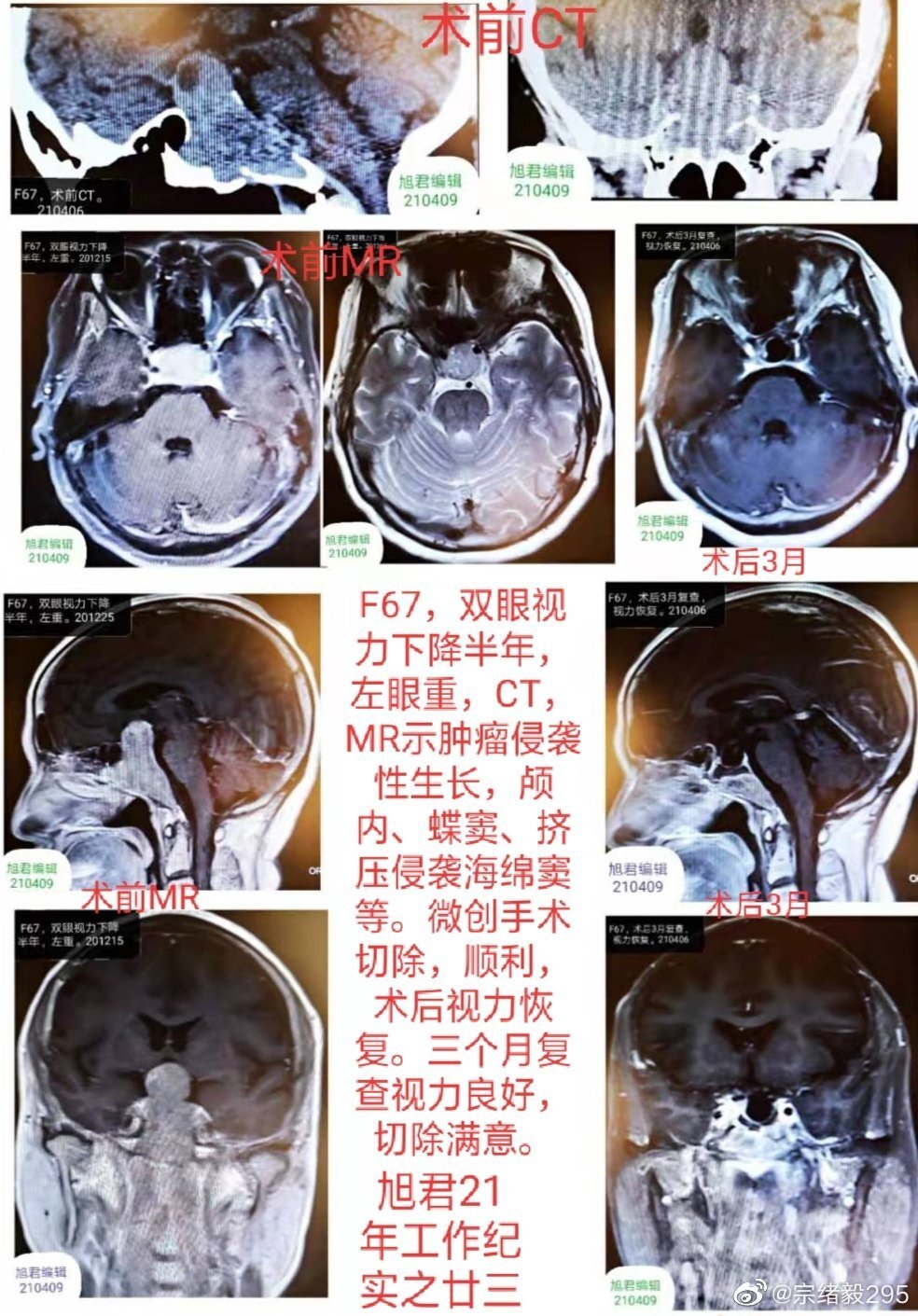 最近通過ct發現鞍區病變,mr掃描發現侵襲性垂體腺瘤,向顱內,蝶竇內