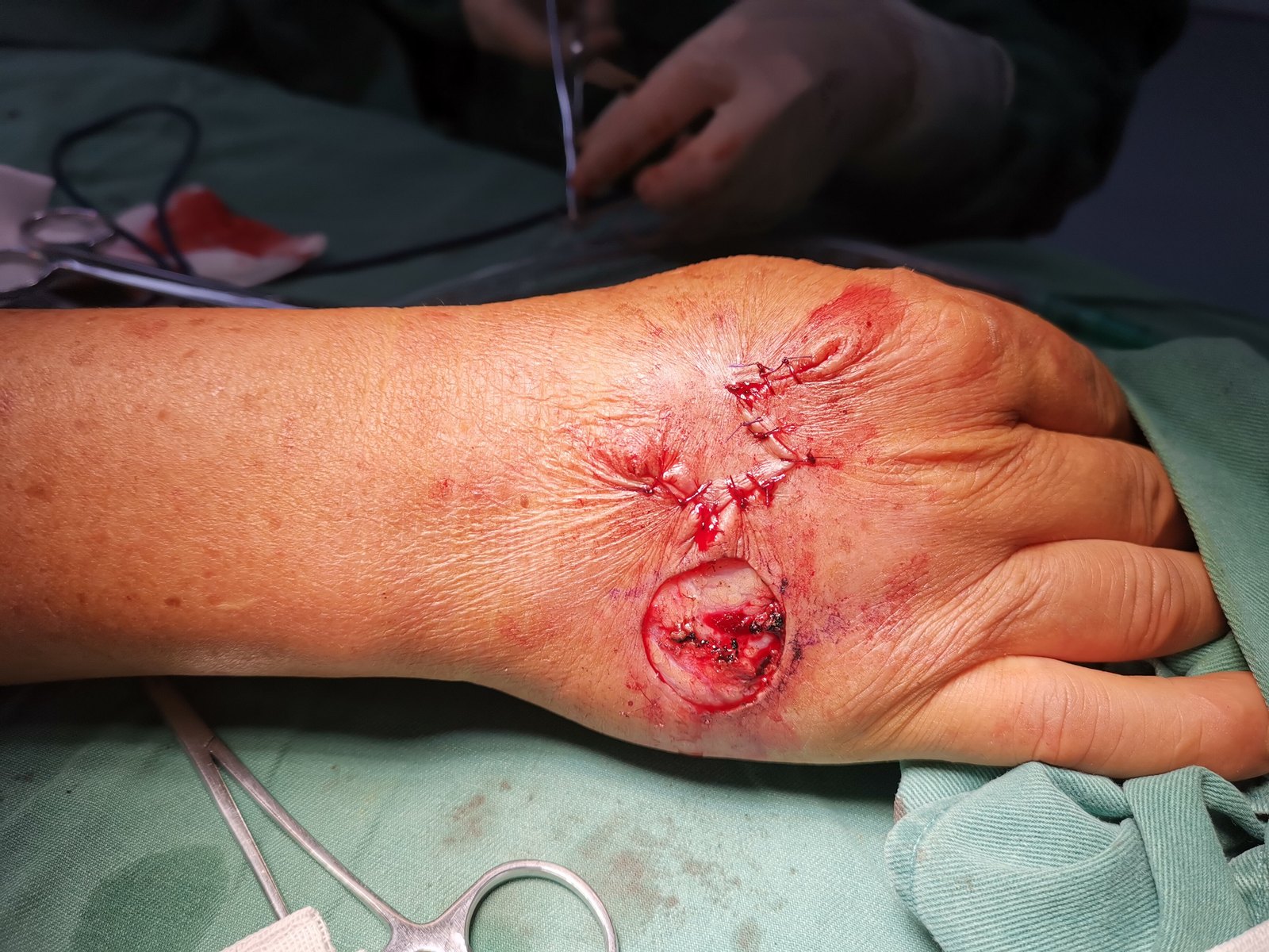 皮肤鳞癌扩大切除_鳞状细胞癌_鳞状细胞癌治疗方式 - 好大夫在线