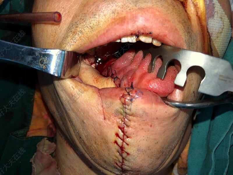 牙龈癌手术后面部照片图片