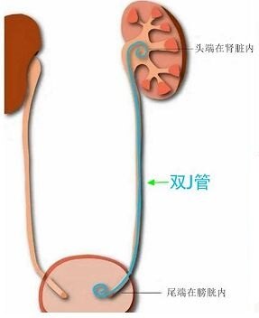 输尿管支架取出过程图图片