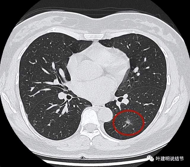 没什么变化,只展示左下主病灶5):叶主任,这是据上次ct一个月拍的薄层