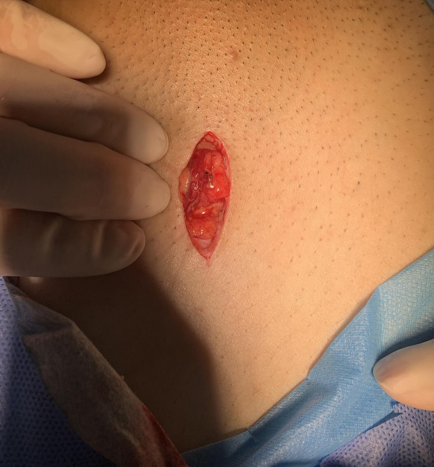 更小的切口更微创无血手术治疗男性胡桃夹综合征精索静脉曲张