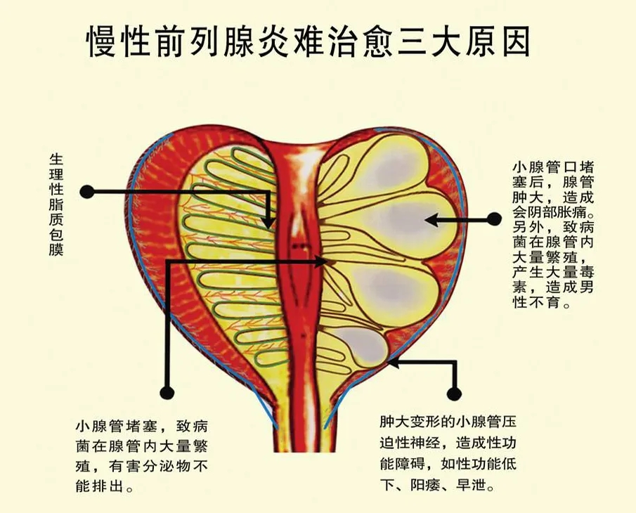 男“炎”之隐—带你走进“前列腺炎”的片场_前列腺炎_介绍_发病原因_症状表现_治疗方式 - 好大夫在线