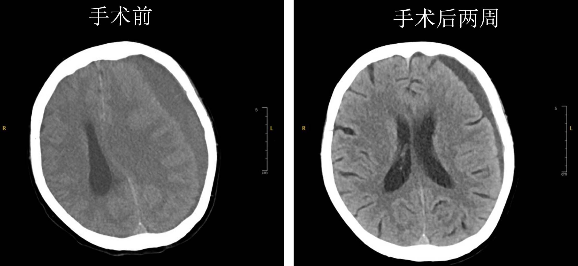 硬膜下血肿ct图图片