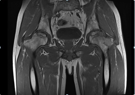 术前的核磁共振数据:双侧股骨头坏死术前的ct数据:双侧股骨头坏死术前