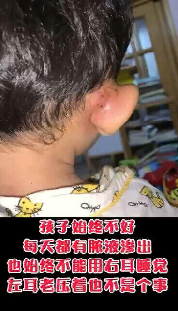 南京耳瘘耳后感染向我求救。