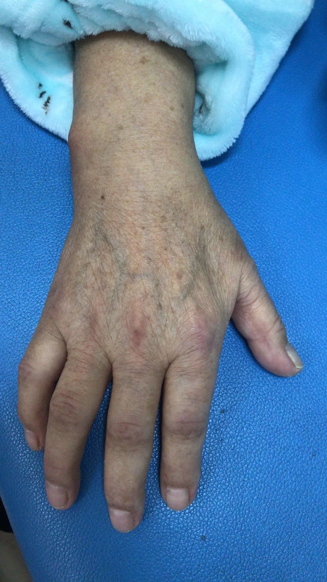 严重肩手综合征----久违的笑容! - 好大夫在线