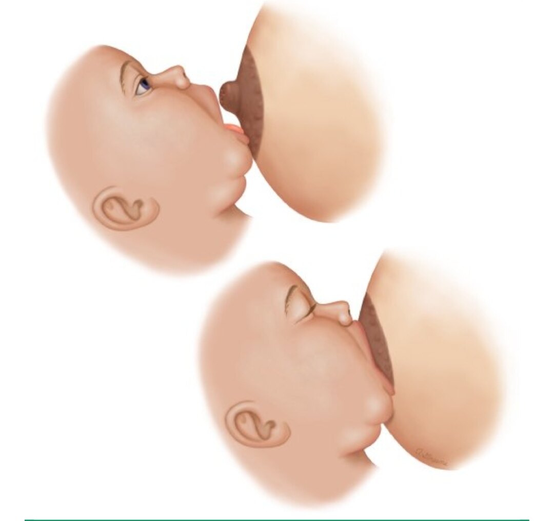 衔乳即婴儿用嘴紧吸乳头及周围深色乳晕(图 1).