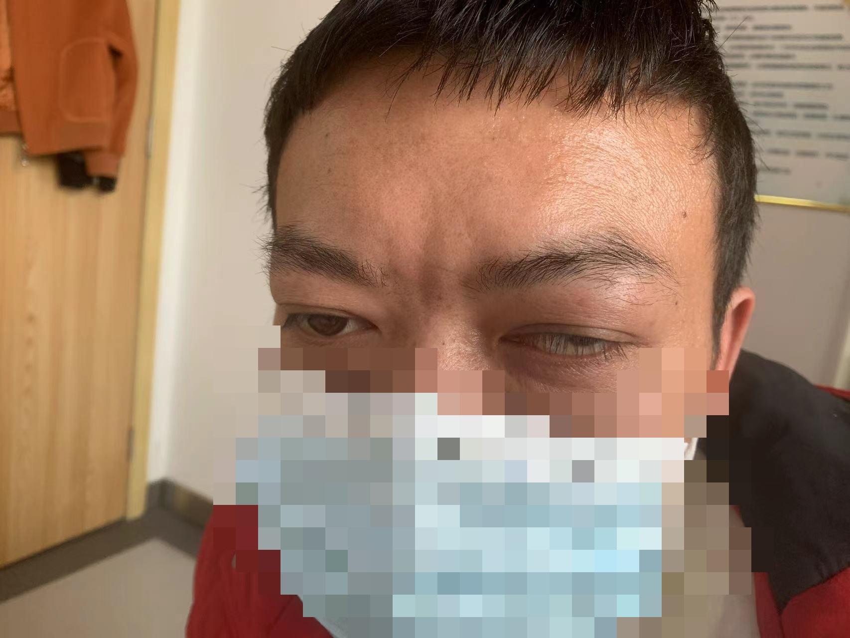 患甲亢服用赛治半年 眼征反而加重 好大夫在线 患甲亢服用赛治半年 眼征反而加重 好大夫在线