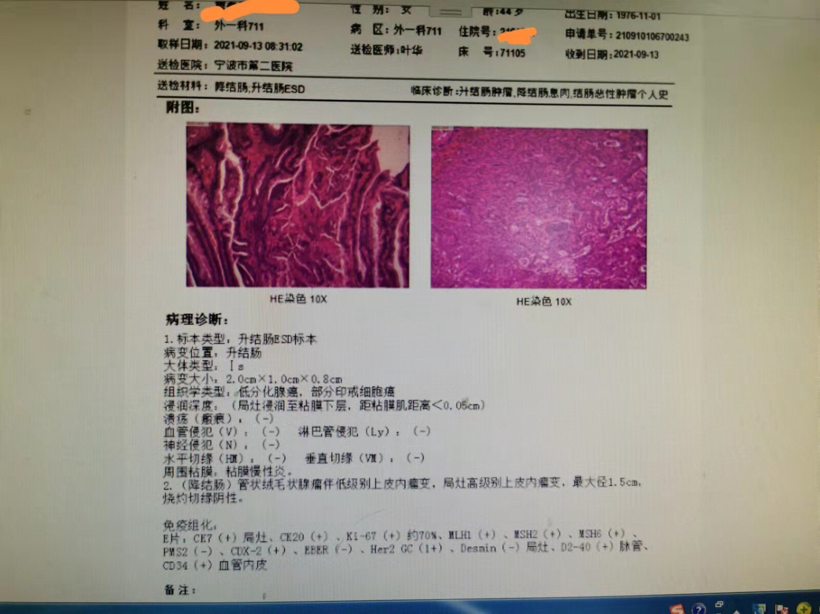 战胜结直肠癌早筛早诊早治才是出路