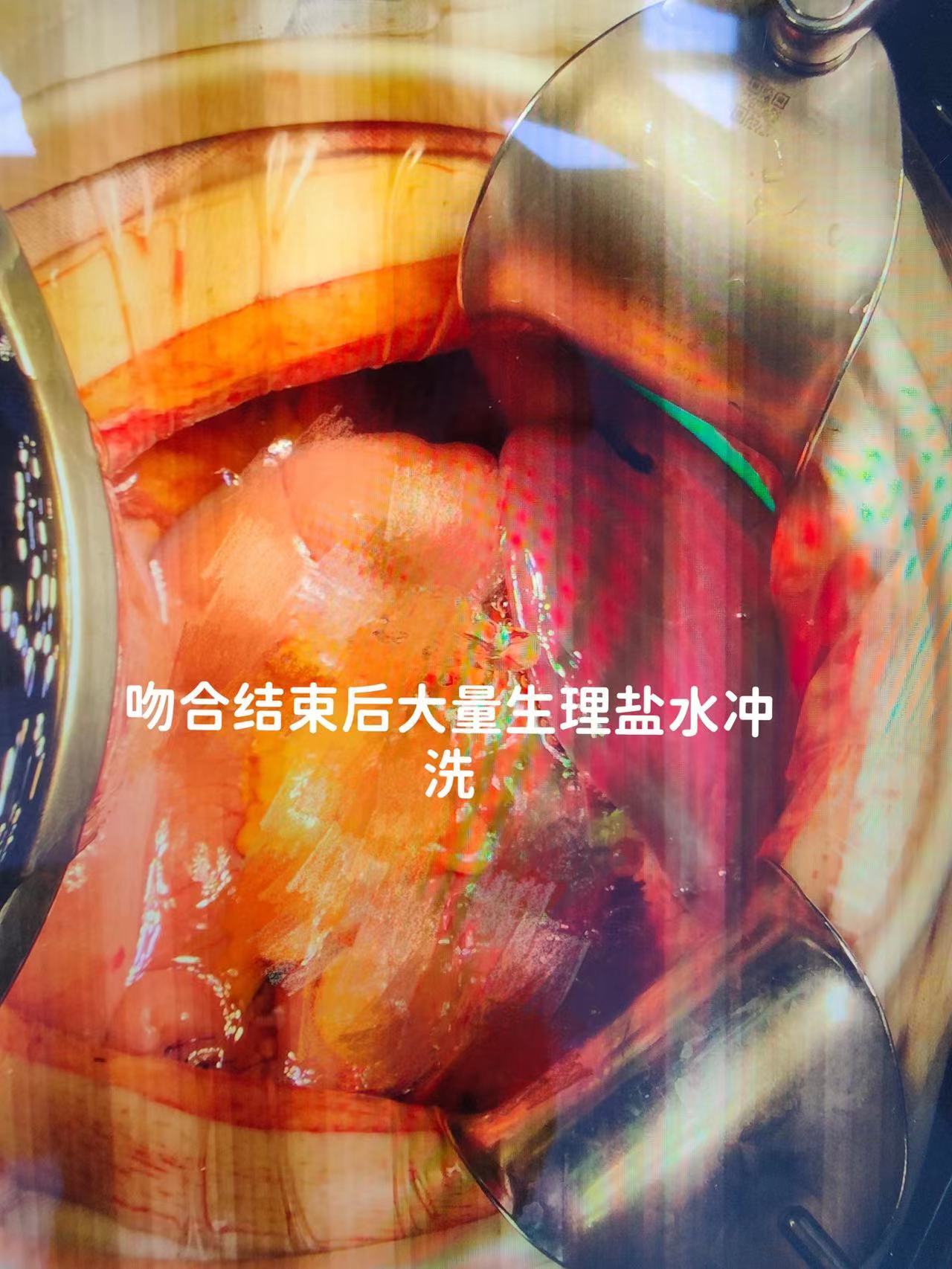 一例胃穿孔患者紧急救治的案例分享_胃穿孔_胃穿孔治疗方式 - 好大夫