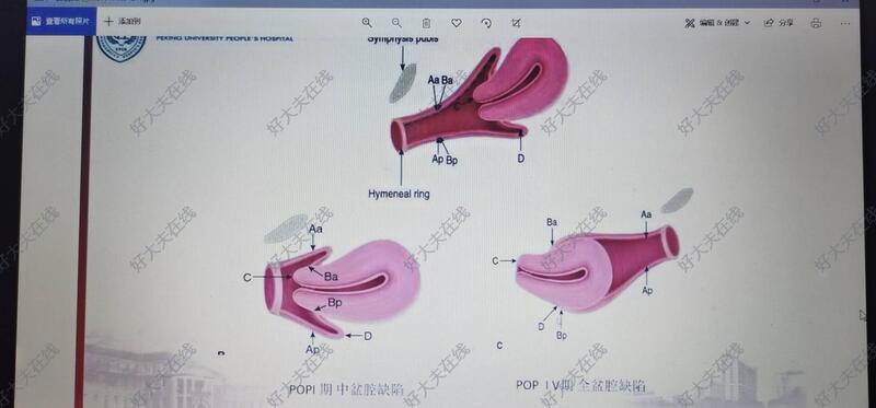 子宫脱垂手术步骤图解图片