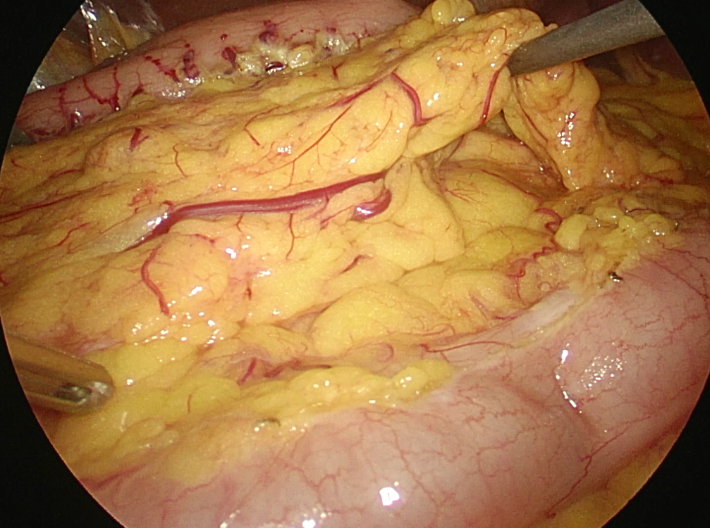 腔镜大网膜游离6.png