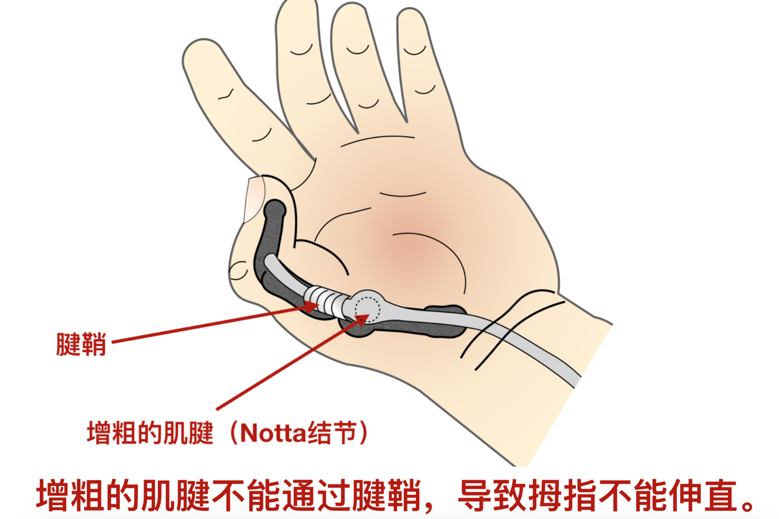 腱鞘炎手术多少钱图片