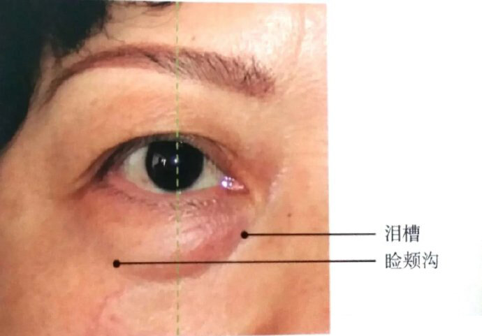 什么是泪沟,睑颊沟,印第安纹(颧颊沟)_去眼袋_去眼袋治疗介绍 - 好