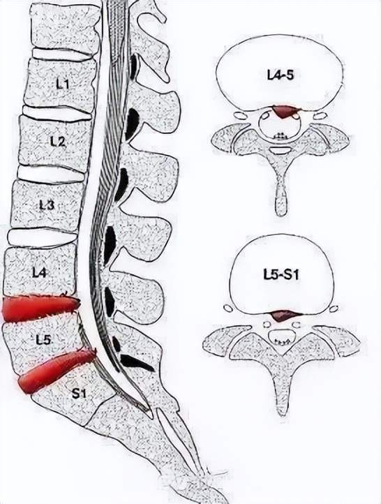 从腰1到腰3这个腰椎活动度相对比较大,灵活性好的区域,移动到了骶骨
