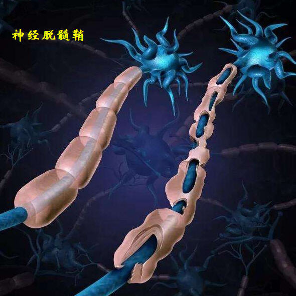 demyelination presenting as optic neuritis,cervical myelitis