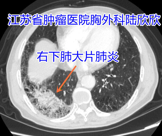 下肺肺炎可疑肿瘤 - 副本.jpg