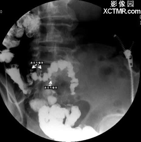 迴腸末段麥克爾憩室gastricmucosalprolapsegmp消化道造影病例圖片