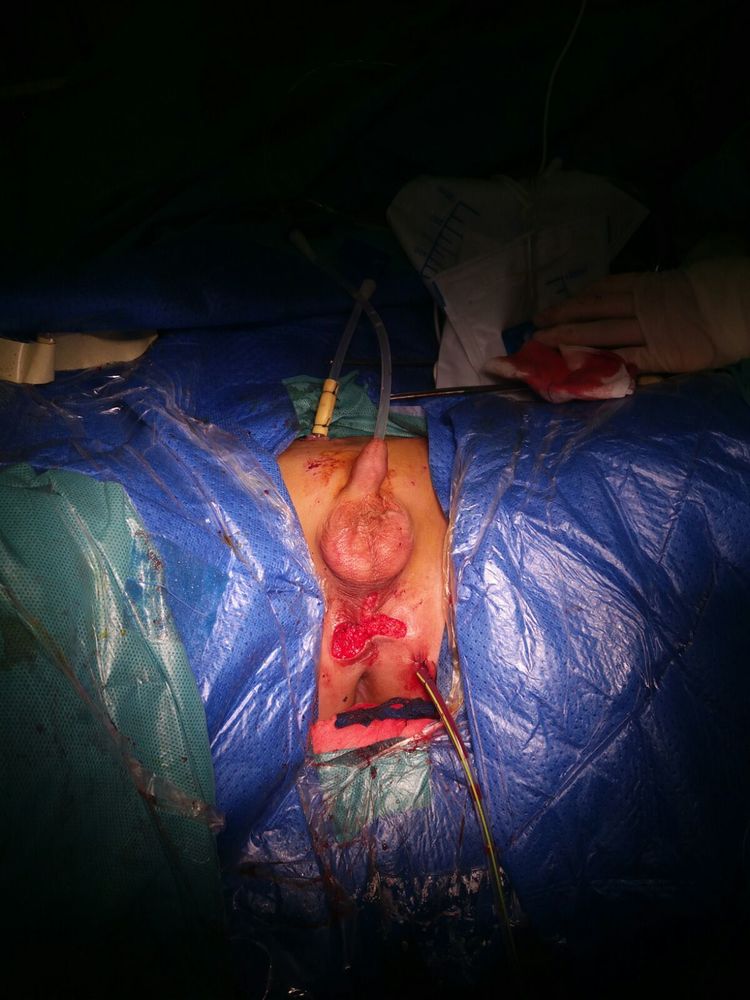 一天三台不同尿道手术