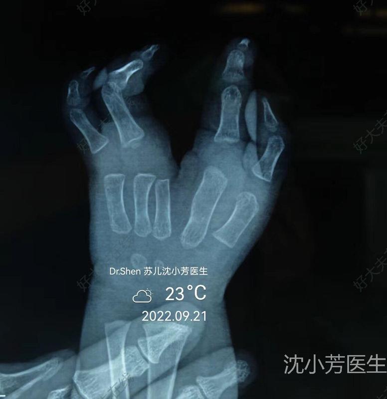 裂手_先天性并指多指畸形 - 好大夫在线