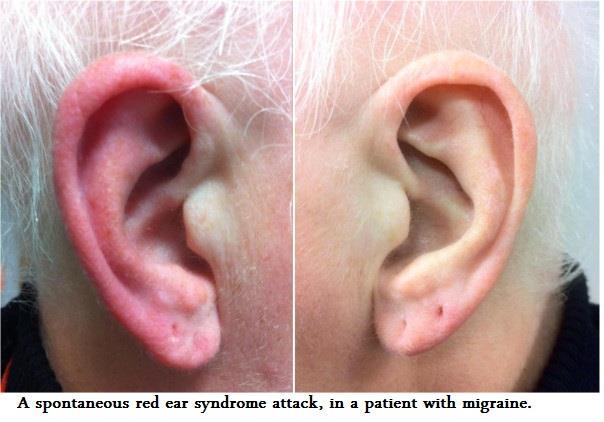 Red Ear Syndrome 2.jpg