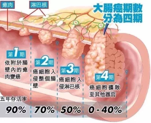 本應該早期發現的結腸癌