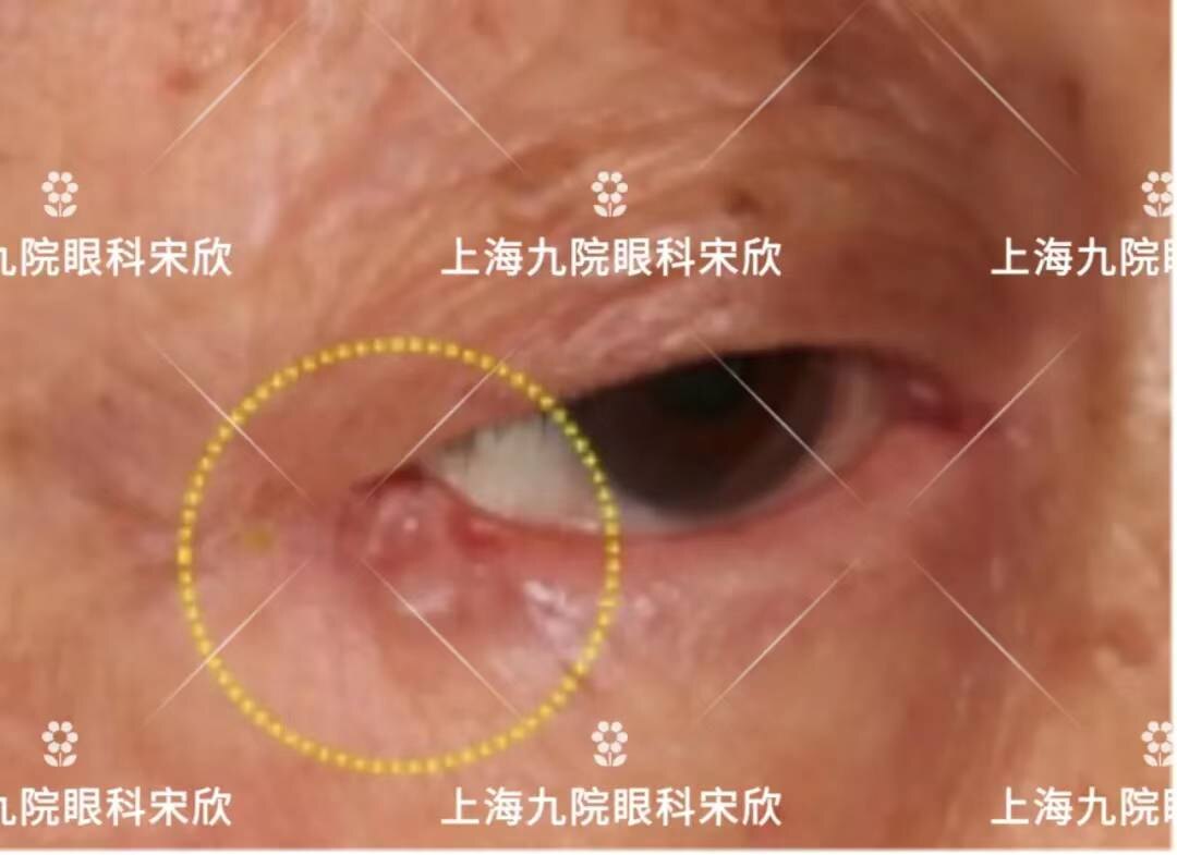 眼腫瘤系列科普都是基底細胞癌一個術後看不出痕跡一個卻失去了眼睛