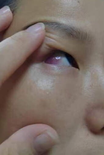 眼红不一定是结膜炎,有可能是巩膜炎,滥用眼药水可能会引起青光眼