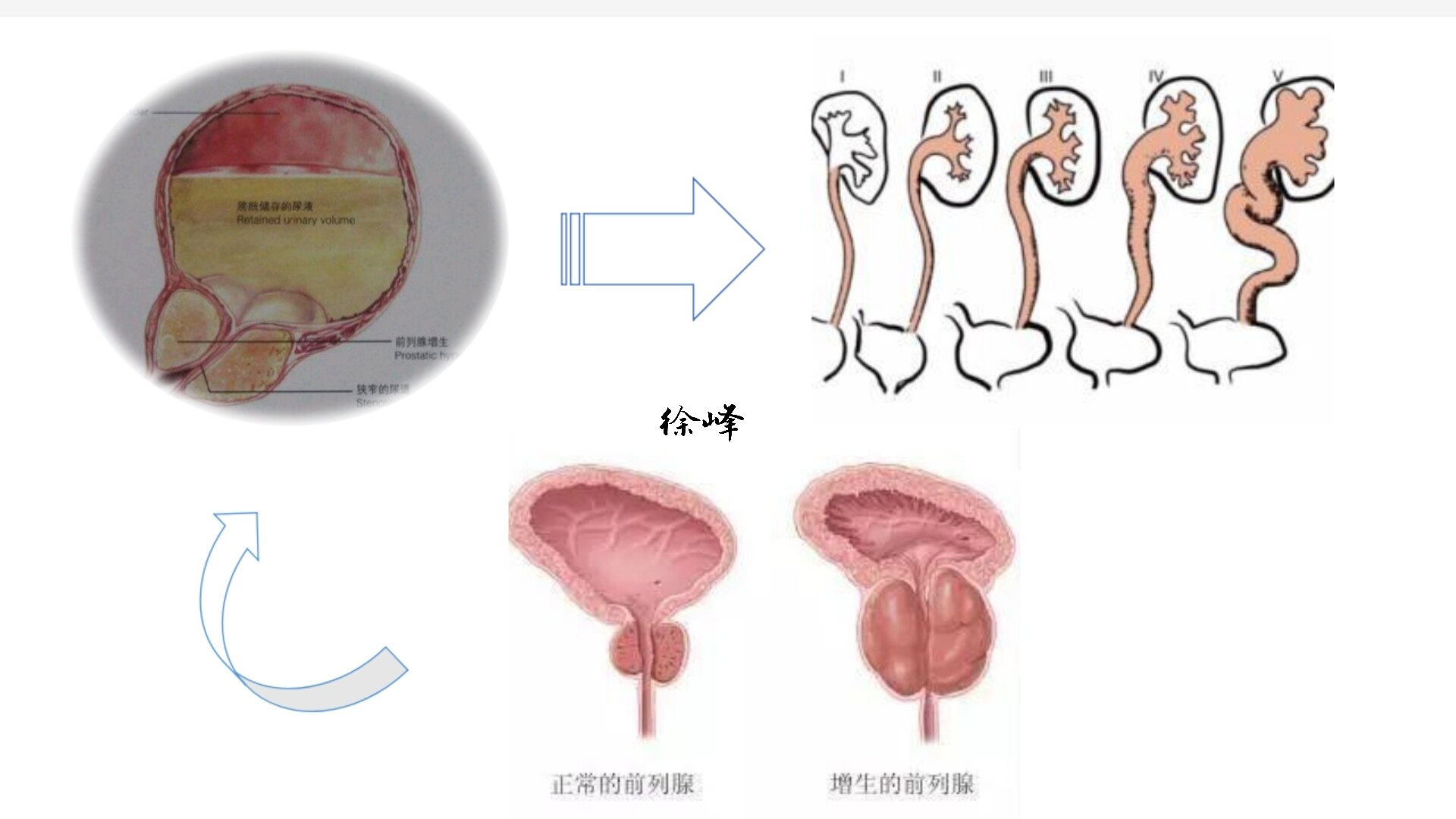 前列腺增生排尿困難尿線變細分叉排尿等待尿頻尿失禁血尿等