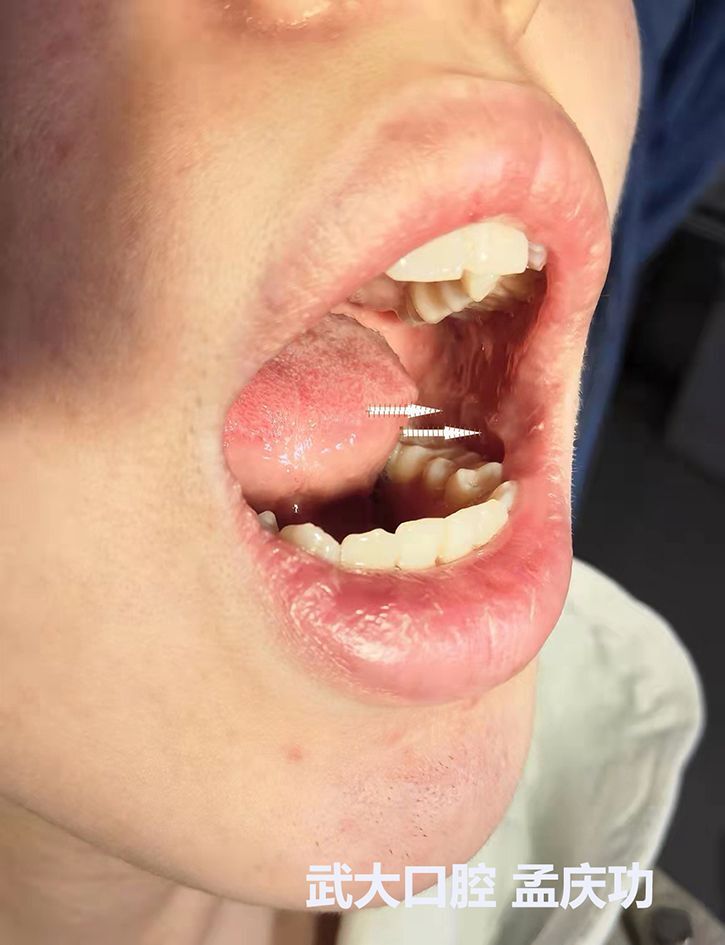 紧咬牙表现为颊黏膜的咬合线明显,带有齿痕