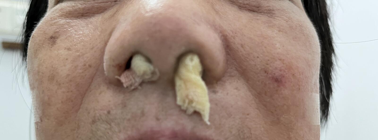 前鼻孔填塞图片