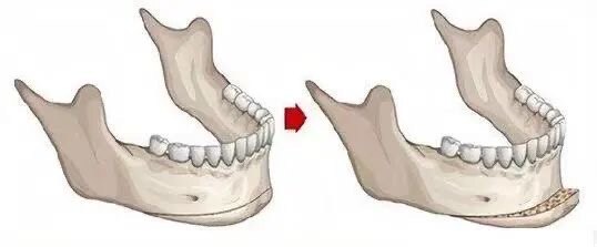 是目前頜面正頜外科手術中,適用範圍比較廣的手術方式,下頜骨太短,後
