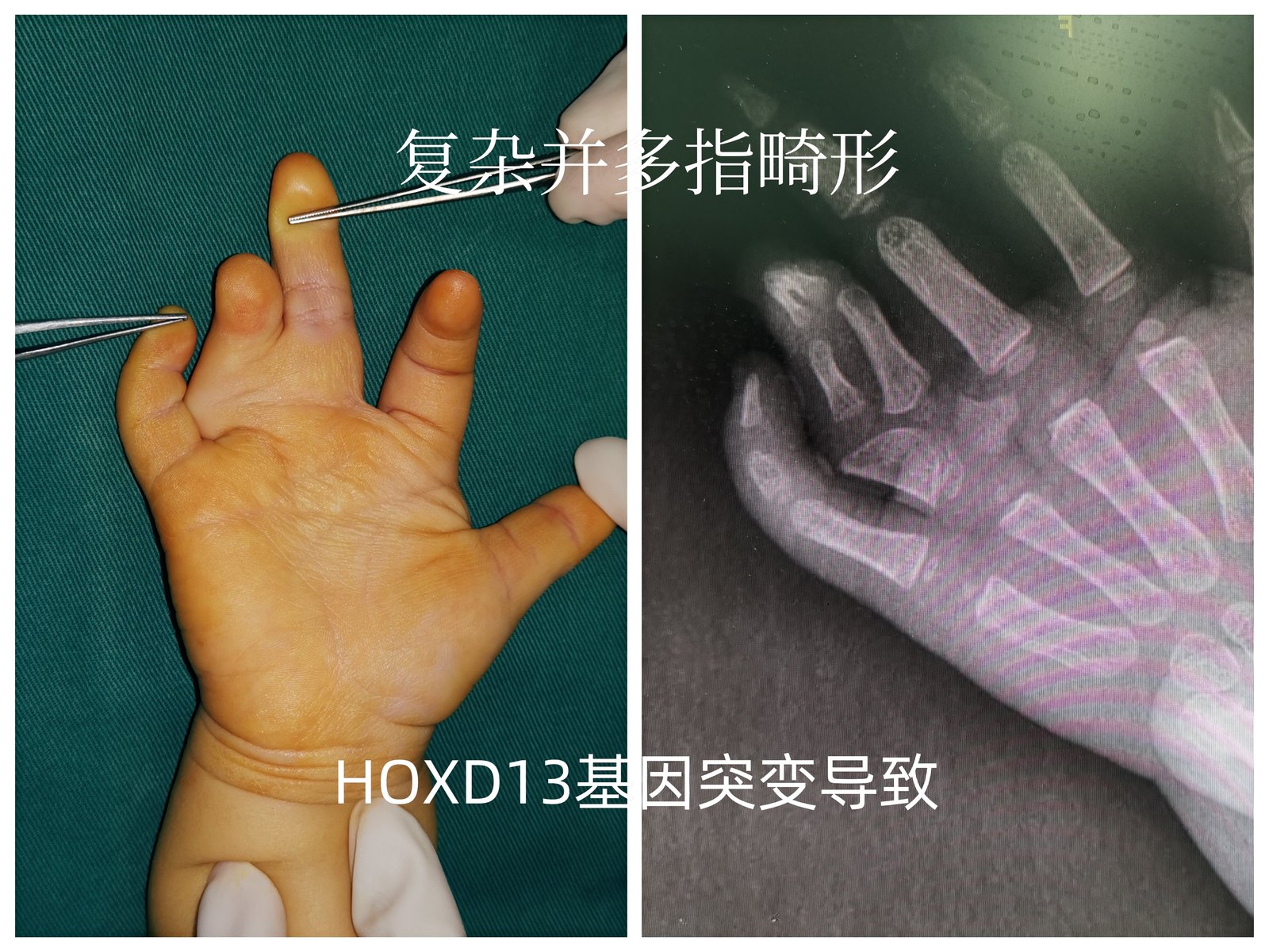 并多指趾畸形的诊断及矫正