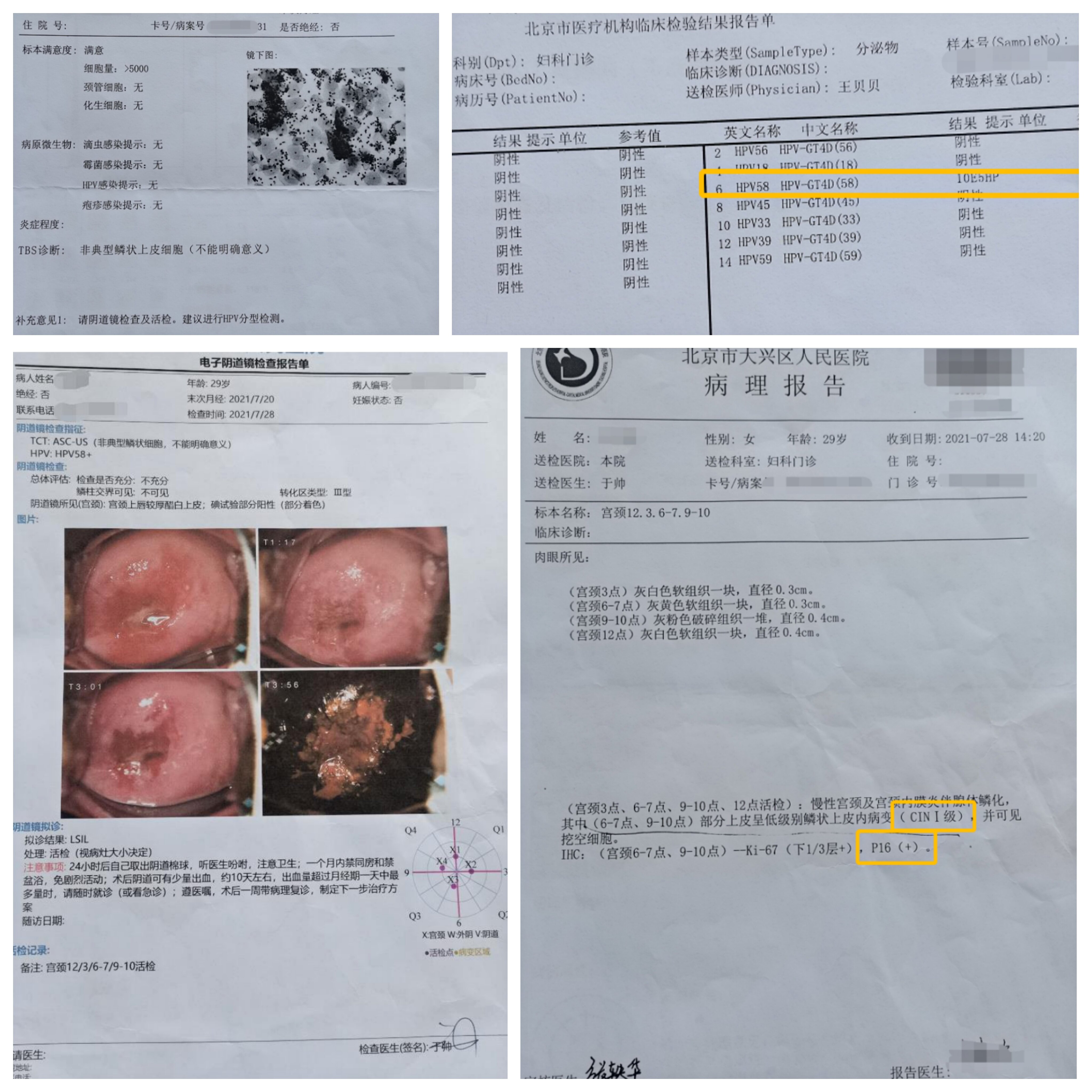 【案例2】30岁女性,hpv16,58阳性,cin1-2的治疗过程及结果