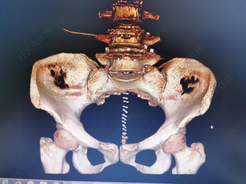 骶骨肿瘤_骨肿瘤 - 好大夫在线