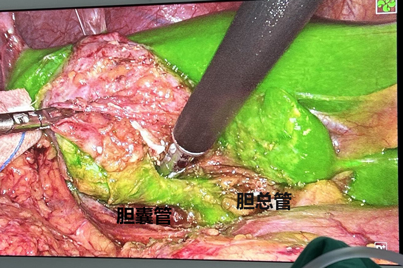 排出肾能结石快速排出来吗_肾结石怎么能快速排出_快速排出肾结石的小偏方