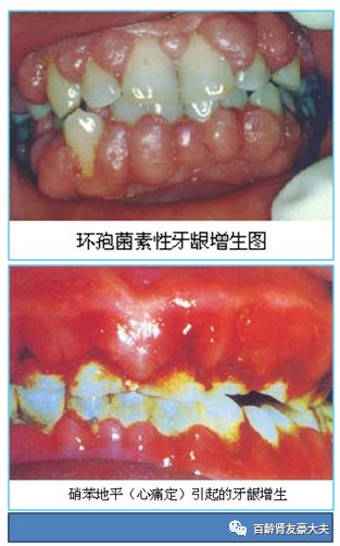 腎移植者牙齦增生怎麼辦出現牙周炎或牙周膿腫時怎麼辦