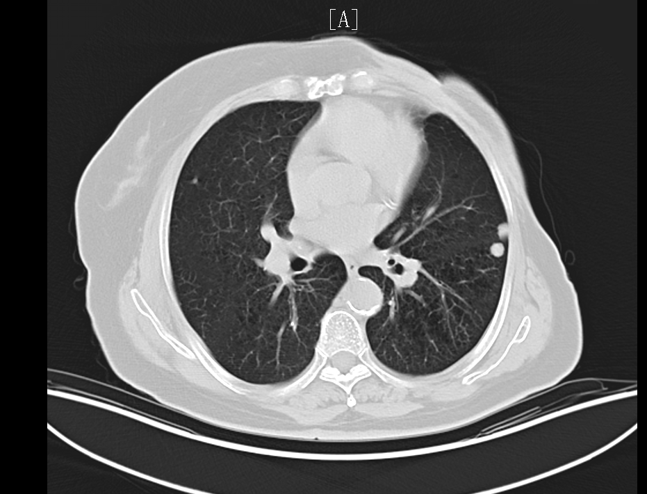 乳腺癌ct片图片图片