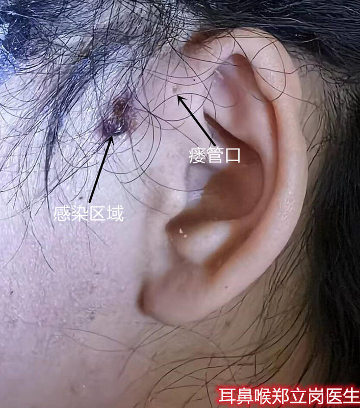 对于先天性耳前瘘管来说,一般医生都建议感染控制后再手术治疗