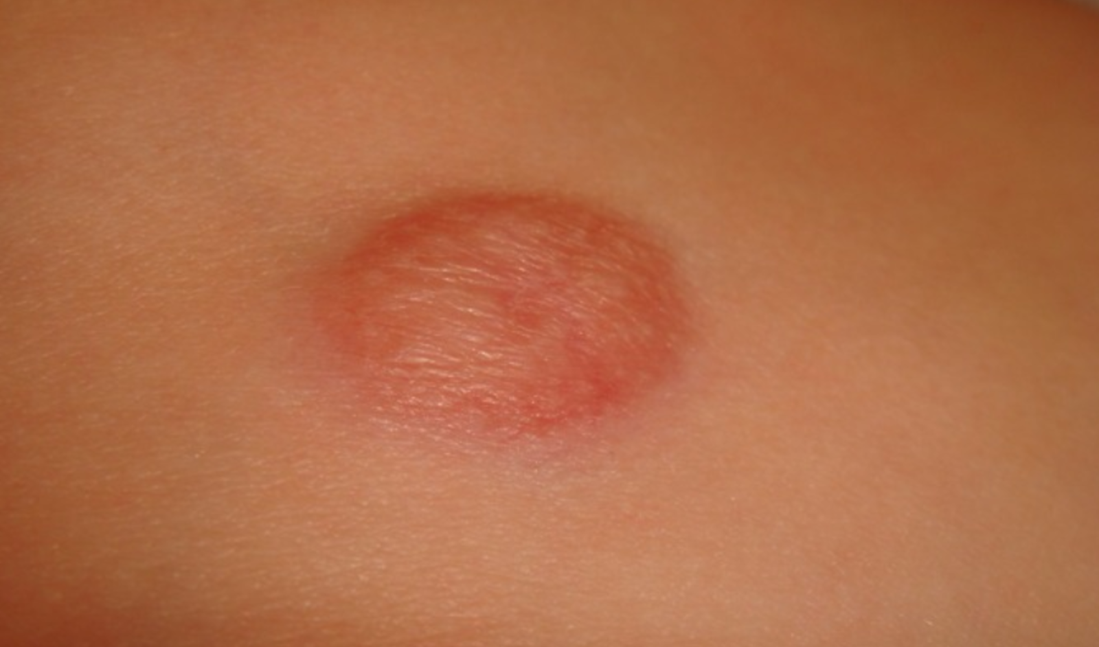皮肤肉瘤早期图片图片