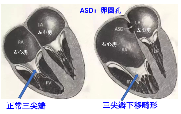 三尖瓣下降畸形.png