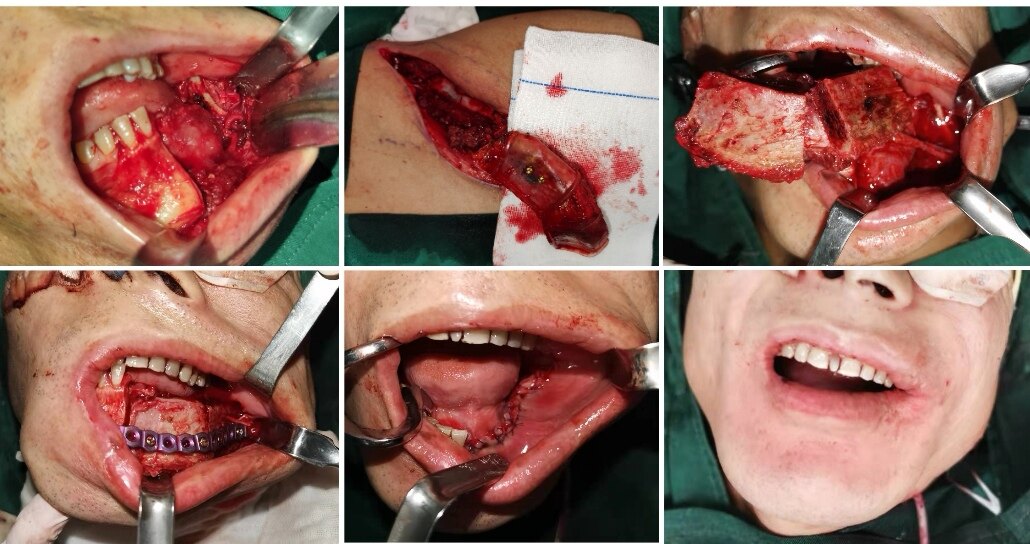 没有面部切口的颌骨肿瘤切除及修复重建微创技术