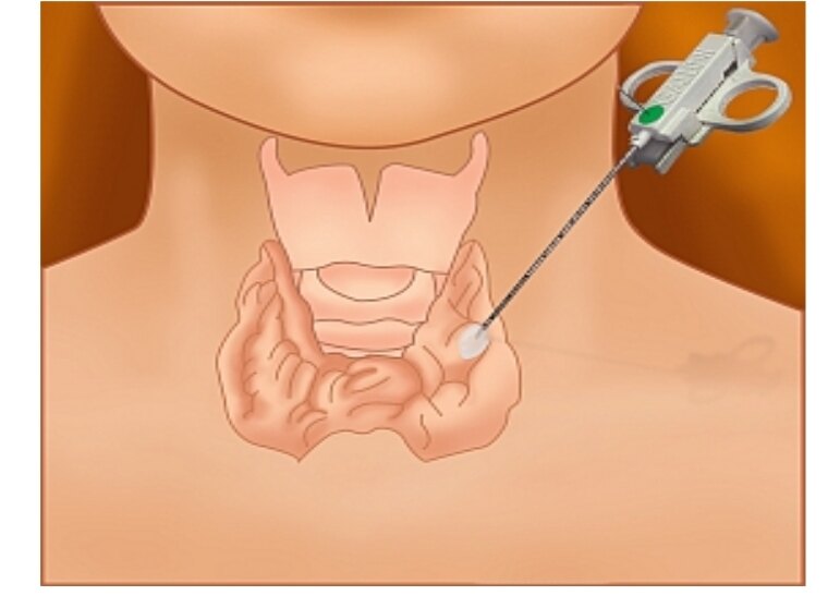 图一,甲状腺及颈部淋巴结穿刺示意图图二,颈部淋巴结的区域划分示意图