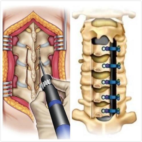颈椎后路手术:单开门椎管扩大椎板成型术 