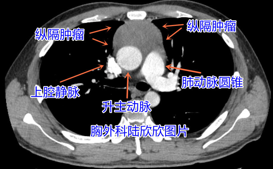 术前肿瘤水印.jpg