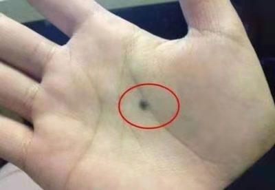 破溃,出血等;3色素痣短期内迅速增大,出现卫星灶,色素痣颜色和形状