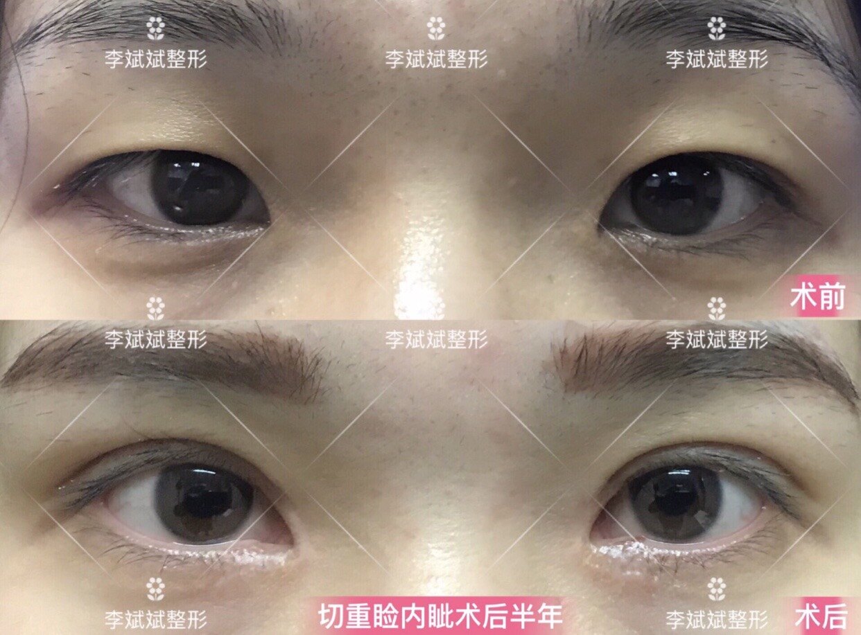 双眼皮双眼皮开内眼角案例合集
